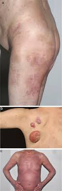 Lymphomas are cancers that result from a type of white blood cell that grows out of control. Management Of Cutaneous T Cell Lymphoma Rcp Journals