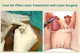 Contact us · sales & business dev. How Much Does It Cost For Piles Laser Treatment And Laser Surgery Laser Piles Clinic