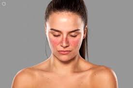 Anyone can get lupus, but women are more likely to get. Lupus What Is It Symptoms Causes Prevention And Treatment Top Doctors
