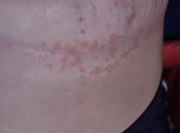 Image result for heat rash under breasts