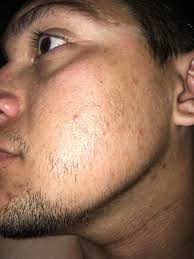 Minoxidil günstig bestellt und schnell geliefert. 3 Months Minox 5 At Beard Profile Forum
