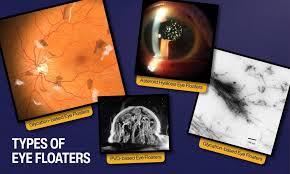 Image result for Floaters