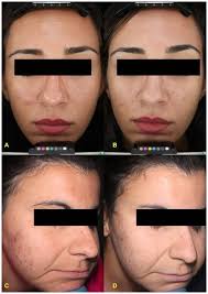 Advanced digital photography of two patients affected by mild acne at...