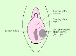 Image result for Bartholin's gland abscess