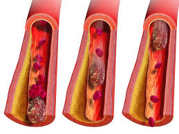 Normally, blood flows freely through veins and arteries. Ultrasound Drill Dissolves Deep Blood Clots With Impeccable Precision Cardiology
