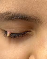 Image result for cornu cutaneum)