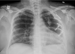 Image result for Flail Chest