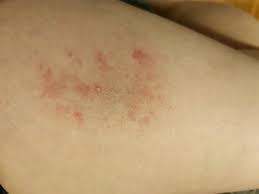 Image result for koebner phenomenon psoriasis