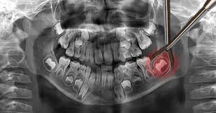 Bite down firmly but gently on the rolled gauze pads. Wisdom Teeth Removal After 30 Must Know Semiahmoo Dental
