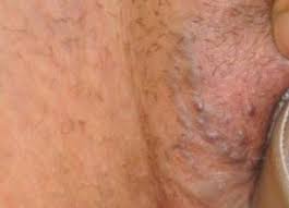 Quien Con Varices Vulvares Club De Bebes Septiembre 2021 Babycenter