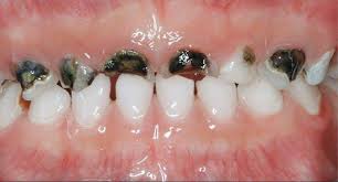 Check spelling or type a new query. Why Children Have Rotten Teeth Dr Larika Robb