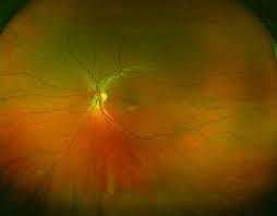 The optos® retinal screening is an important part of our routine eye exams. Optos Retinal Imaging Optik Pdx