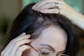 ( 5) journaling and yoga are great natural stress relievers. The Answer To My Thinning Hair Dilemma Michelletyler