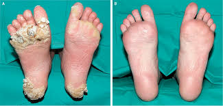 Plantar warts can be painful, annoying and embarrassing, so knowing how to treat warts on your feet can alleviate pain, discomfort and the social stigma that come along with the condition. Severe Plantar Warts In An Immunocompromised Patient Nejm