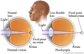 Image result for Presbyopia