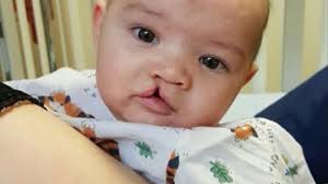 Fundraiser by Loren Mac : Gavins cleft lip repair