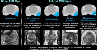 Image result for Prostate Cancer Staging