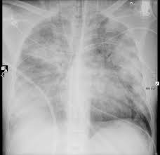 Elle est causée par la bactérie legionella, qui vit dans les sources d'eau naturelles et certaines installations, comme les tours de. Legionella Pneumonia Radiology Reference Article Radiopaedia Org