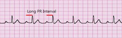 Rhythm Recognition Acls Medical Training