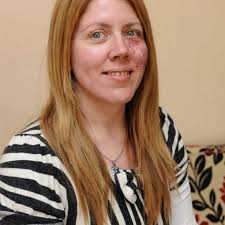 Brave mum Samantha Bohan tells how she stood up to the bullies who made her  life hell because of birthmark