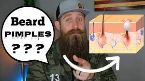 Its unscented formula along with aloe vera works well to smoothen your skin and keep it moisturized. Beard Pimples Cause And Solution Youtube
