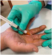 Image result for Dactylitis