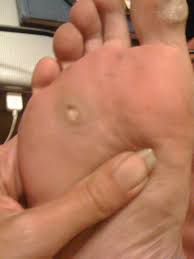 Podiatrists are medical experts who specialise in treating the disorders of feet, ankles, and lower legs. All About Trying To Get Rid Of My Huge Disgusting Verruca Tales From The River