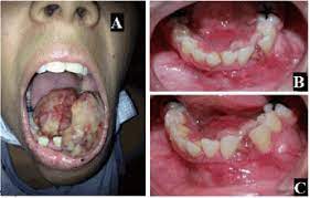 Cancer in the bones of the spine can press on nerves, causing numbness and tingling or even. Rare Case Of Mandibular Osteosarcoma Clinical Imaging And Pathological Aspects