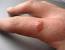 Finger Pimple Like Bumps