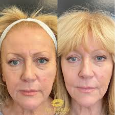 Victoria C, RN (@trubeauty_rninjectorvictoria) • Instagram photos and videos