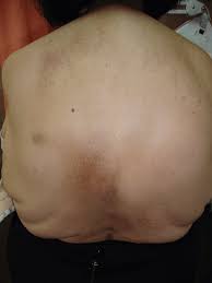 The intrinsic back muscles, which are also called true back muscles. Racgp Chronic Itch On The Back Associated With Disc Hernia A Case Study