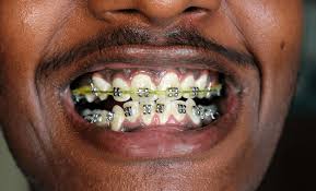 However, considering those variations, insurance, and location, the average cost of braces for adults could be between $4,800 and $7,000. Cost Of Dental Braces In Nigeria July 2021