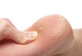 Verruca pictures of dying plantar warts. Plantar Warts Verrucae Perform Podiatry