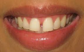 Gaps in between teeth usually tend to look ugly, n people tend to rush to the orthodontist most often. Gap In Front Teeth Problems And Their Solutions Gap Teeth Dentistry Dental Problems