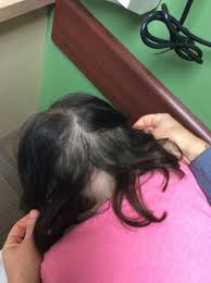 Hair loss due to thyroid disease becomes apparent several months after the onset of thyroid disease. Alopecia Areata And Hypothyroidism Endocrinology