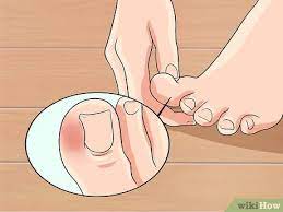 If the infection worsens or is left untreated, you may develop a fever. 3 Ways To Cure An Infected Toe Wikihow