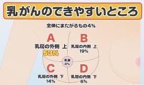「乳がん」の画像検索結果