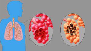 Learn about symptoms, treatments, and tips for living with chronic obstructive pulmonary disease (copd), and read about nhlbi research and clinical trials. Ø§Ù†ØªÙØ§Ø® Ø§Ù„Ø±Ø¦Ø© Ø§Ù„Ø£Ø³Ø¨Ø§Ø¨ ÙˆØ§Ù„Ø£Ø¹Ø±Ø§Ø¶ ÙˆØ§Ù„ØªØ´Ø®ÙŠØµ ÙˆØ§Ù„Ø¹Ù„Ø§Ø¬ Ø£Ù†Ø§ Ø£ØµØ¯Ù‚ Ø§Ù„Ø¹Ù„Ù…