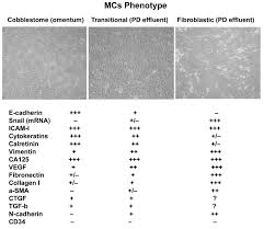 Asbestos exposure is the only known cause of all mesothelioma cell types. The Mesothelial To Mesenchymal Transition A Pathogenic And Therapeutic Key For Peritoneal Membrane Failure Intechopen