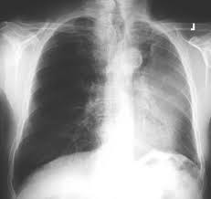 We did not find results for: Luftsichel Sign Lungs Radiology Reference Article Radiopaedia Org