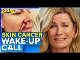 Deb Hutton's skin cancer wake-up call for Australians