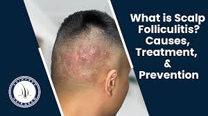 Image result for folliculitis symptoms