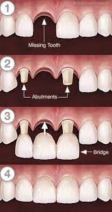 Check spelling or type a new query. Dental Bridge Smile Dental Studio