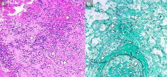 Development of pcr negativity after treatment was associated with higher survival rates (48% vs 4. Agents Of Mucormycosis Clinical Condition Infectious Disease Advisor