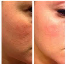 acne scars before after yelp