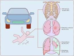 Image result for Chest Trauma
