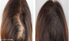 افضل بروتين للشعر من الصيدليه