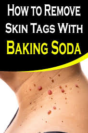 How To Remove Skin Tags With Baking Soda And Castor Oil Skin Tag Removal Skin Tag Oils For Skin