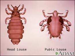 Image result for pubic lice symptoms