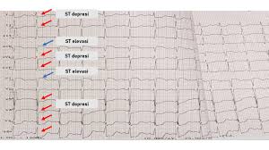 Check spelling or type a new query. Kurniawan Prakoso Auf Twitter Berarti Ekg Pasien Left Main Multivessel Disease Udah Nggak Perlu Dibahas Ya Karena Ekg Nya Sama Kayak Pasien Yang Sebelumnya Gue Post St Depresi Diffuse 8 Lead Elevasi